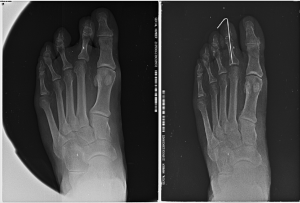 Comparativa de el pie en el preoperatorio y el postoperatorio