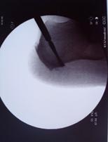 Imagen intraoperatoria con miniview, incisión sobre el Calcaneo